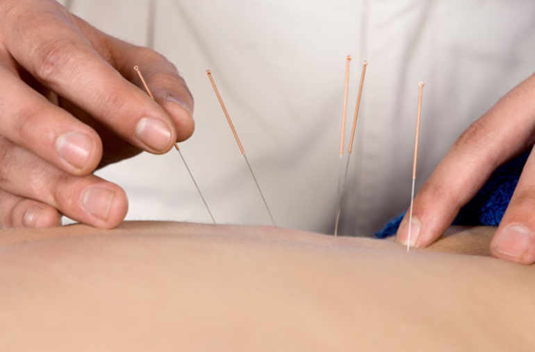 De l’acupuncture avant l’opération?