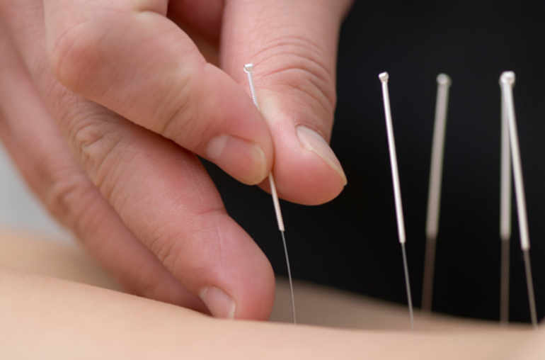 Soigner la douleur par l'acupuncture