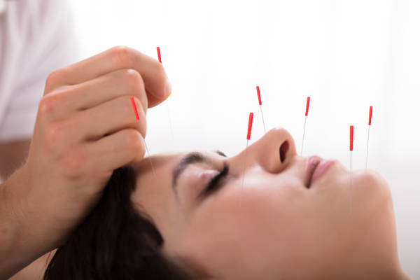 Illustré_migraine_acupuncture